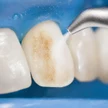 69a1a7ef-e920-4e1f-9d9e-04ca906973f0-25-air-polishing-one-tooth.jpg