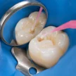 3cec90b4-b5a6-42c1-8b1e-9f4228d73c14-33-superficial-caries-treatment.jpg
