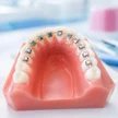 d3f866d8-6c13-4c49-ac5b-a0d0fa19aee4-13-self-ligating-braces-adjustment-one-jaw.jpg