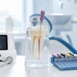 780b4a66-e337-48a3-a076-672cbd75d5a5-30-single-root-canal-filling.jpg